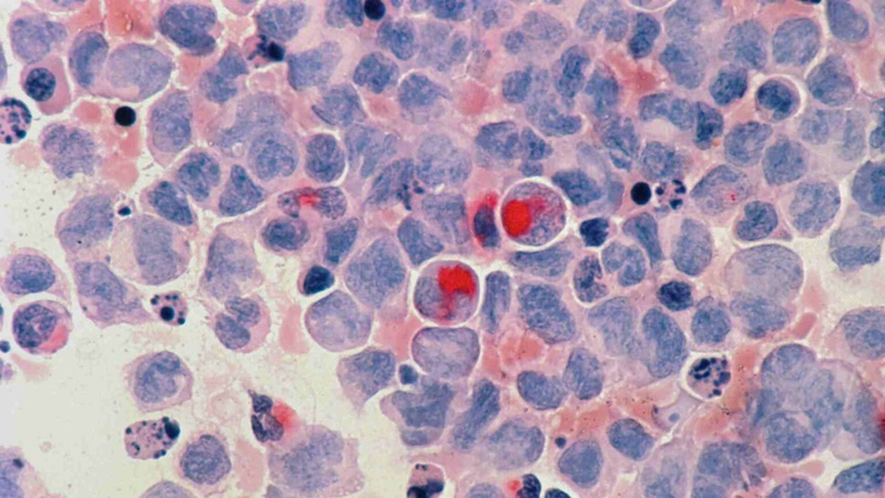 mas-de-18-millones-de-personas-en-el-mundo-moriran-de-cancer-en-2050-un-75-mas-que-ahora-1536x864