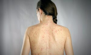 alerta-sarampion-scaled-e1717776684793