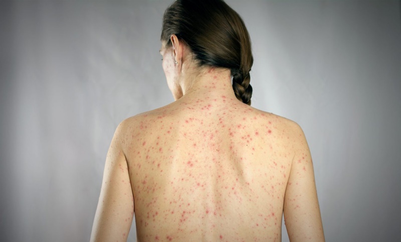 alerta-sarampion-scaled-e1717776684793