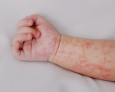 Fig_03_measles_baby_arm