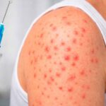 Sarampión repunta en México con más de 14 mil casos