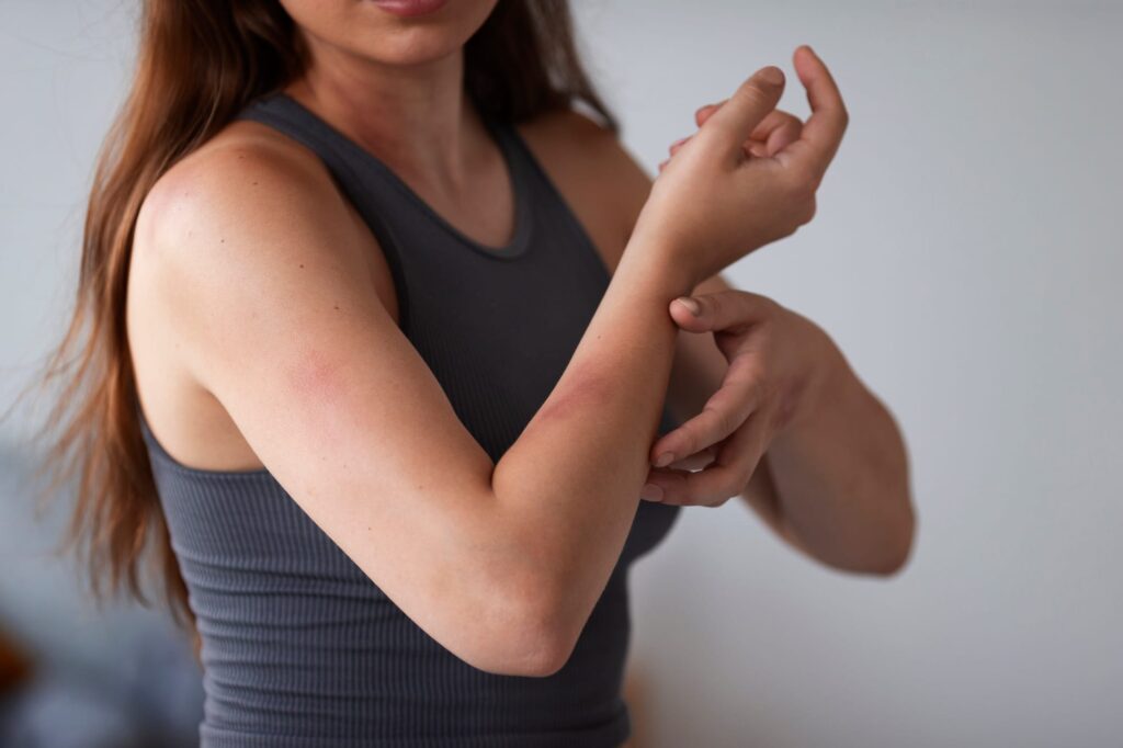 Urticaria-por-estre-s--conoce-ma-s-sobre-esta-alergia-nerviosa