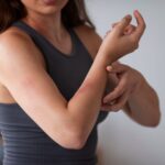 El estrés no solo afecta tu mente: también puede empeorar la dermatitis