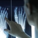 Dedos en martillo y en mazo: una deformidad común que afecta más a mujeres